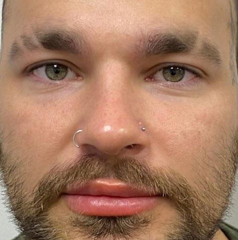 Before Buccal Fat Removal
