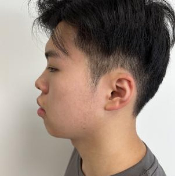 Before Chin Surgery